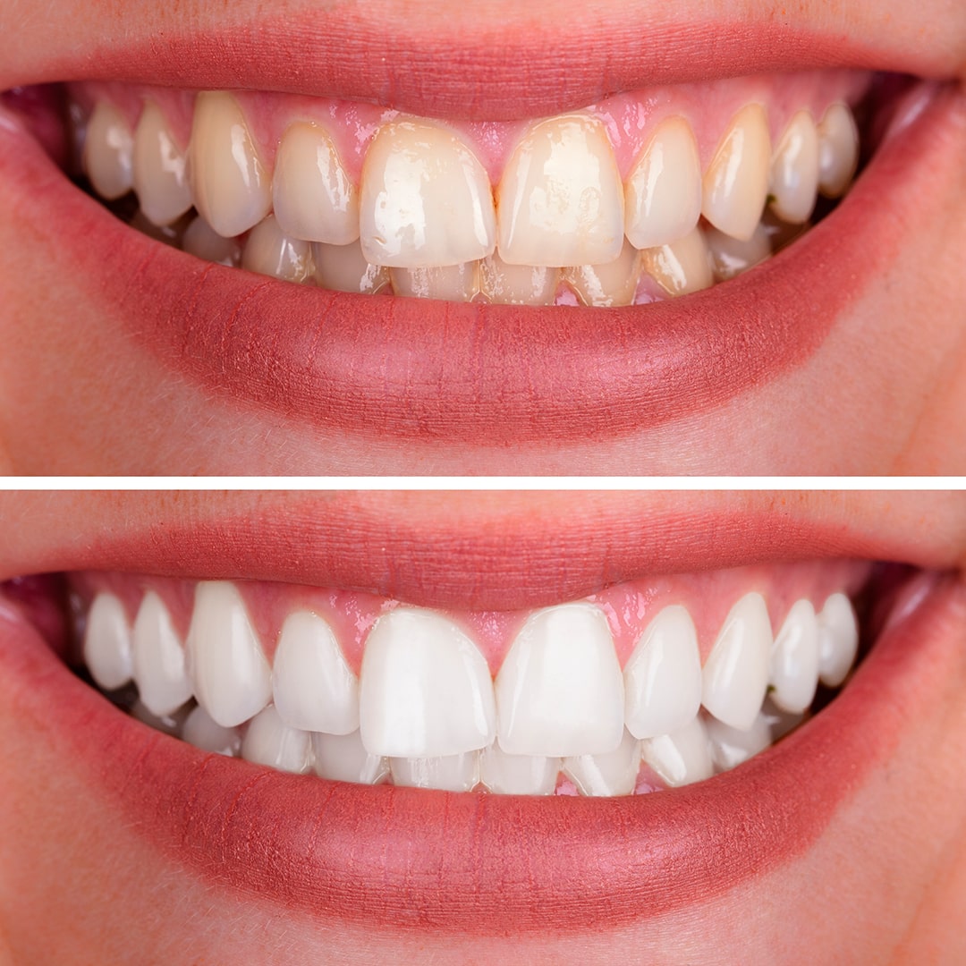 Clareamento Dental - Odontoclinic