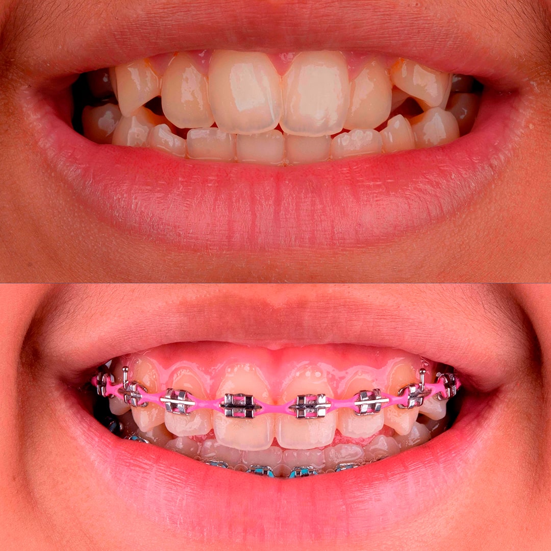 Aparelho Dental - Odontoclinic